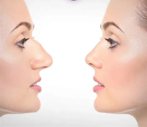 جراحی بینی برای بیماران قلبی ممکن است؟