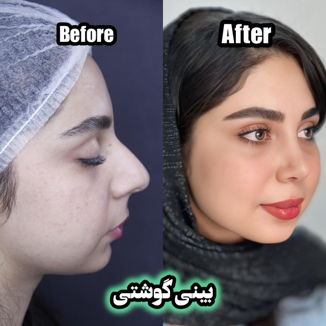 تفاوت بینی گوشتی و استخوانی در جراحی زیبایی