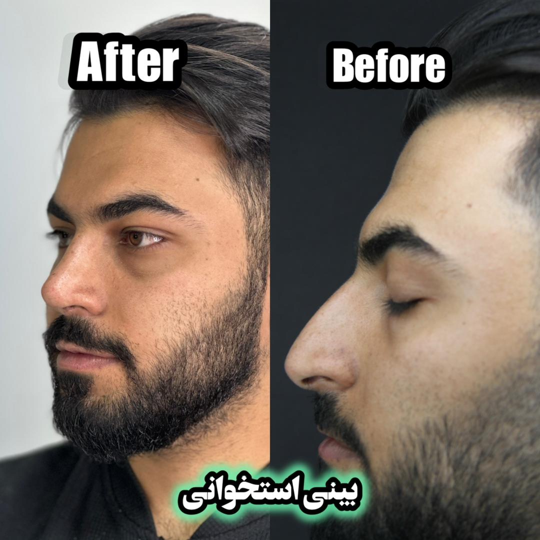 تفاوت های جراحی بینی در مردان و زنان