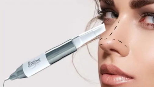 رینوپلاستی اولتراسونیک چیست؟